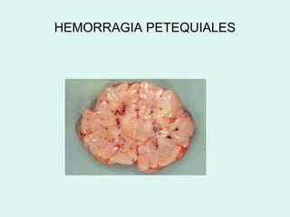 HEMORRAGIA PETEQUIALES
 