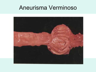 Aneurisma Verminoso
 