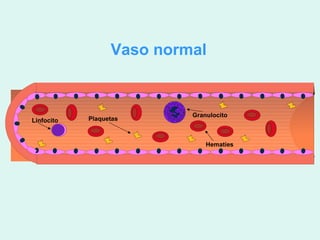 Vaso normal


                           Granulocito
Linfocito   Plaquetas



                               Hematíes
 