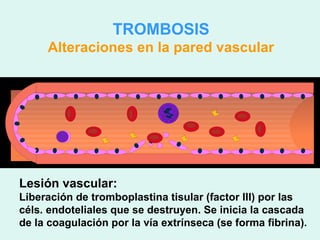 TROMBOSIS
     Alteraciones en la pared vascular




Lesión vascular:
Liberación de tromboplastina tisular (factor III) por las
céls. endoteliales que se destruyen. Se inicia la cascada
de la coagulación por la vía extrínseca (se forma fibrina).
 