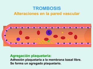 TROMBOSIS
  Alteraciones en la pared vascular




Agregación plaquetaria:
Adhesión plaquetaria a la membrana basal libre.
Se forma un agregado plaquetario.
 