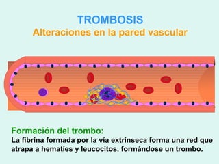 TROMBOSIS
      Alteraciones en la pared vascular




Formación del trombo:
La fibrina formada por la vía extrínseca forma una red que
atrapa a hematíes y leucocitos, formándose un trombo.
 