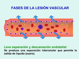 FASES DE LA LESIÓN VASCULAR




Leve separación y descamación endotelial:
Se produce una separación intercelular que permite la
salida de líquido (suero).
 