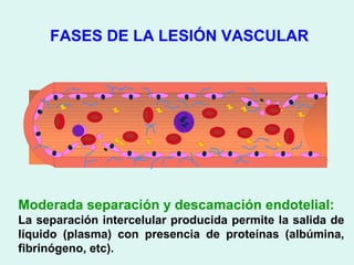 FASES DE LA LESIÓN VASCULAR




Moderada separación y descamación endotelial:
La separación intercelular producida permite la salida de
líquido (plasma) con presencia de proteínas (albúmina,
fibrinógeno, etc).
 