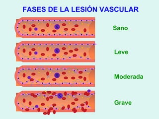 FASES DE LA LESIÓN VASCULAR

                     Sano


                     Leve



                     Moderada



                     Grave
 