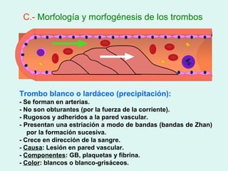 C.- Morfología y morfogénesis de los trombos




Trombo blanco o lardáceo (precipitación):
- Se forman en arterias.
- No son obturantes (por la fuerza de la corriente).
- Rugosos y adheridos a la pared vascular.
- Presentan una estriación a modo de bandas (bandas de Zhan)
   por la formación sucesiva.
- Crece en dirección de la sangre.
- Causa: Lesión en pared vascular.
- Componentes: GB, plaquetas y fibrina.
- Color: blancos o blanco-grisáceos.
 