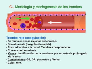 C.- Morfología y morfogénesis de los trombos




Trombo rojo (coagulación):
- Se forma en venas alejadas del corazón.
- Son obturante (coagulación rápida).
- Poco adheridos a la pared. Tienden a desprenderse.
- Crecen contracorriente.
- Causa: Lentificación de la corriente por un estasis prolongado
  de la zona.
- Componentes: GB, GR, plaquetas y fibrina.
- Color: rojo.
 