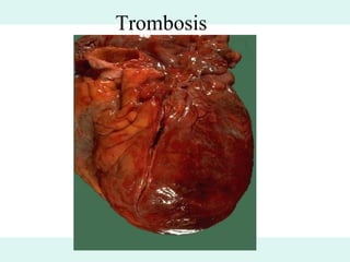 Trombosis
 Trombosis
 