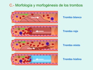 C.- Morfología y morfogénesis de los trombos


                                Trombo blanco




                                Trombo rojo




                                Trombo mixto




                                Trombo hialino
 