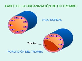 FASES DE LA ORGANIZACIÓN DE UN TROMBO



                     VASO NORMAL




            Trombo


 FORMACIÓN DEL TROMBO
 