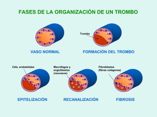 FASES DE LA ORGANIZACIÓN DE UN TROMBO



                                     Trombo




              VASO NORMAL             FORMACIÓN DEL TROMBO


Céls. endoteliales    Macrófagos y            Fibroblastos
                      angioblastos            (fibras colágenas)
                      (neovasos)




    EPITELIZACIÓN            RECANALIZACIÓN                 FIBROSIS
 