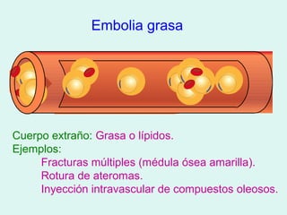 Embolia grasa




Cuerpo extraño: Grasa o lípidos.
Ejemplos:
     Fracturas múltiples (médula ósea amarilla).
     Rotura de ateromas.
     Inyección intravascular de compuestos oleosos.
 