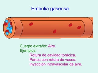 Embolia gaseosa




Cuerpo extraño: Aire.
Ejemplos:
     Rotura de cavidad torácica.
     Partos con rotura de vasos.
     Inyección intravascular de aire.
 