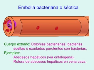 Embolia bacteriana o séptica




Cuerpo extraño: Colonias bacterianas, bacterias
     sueltas o exudados purulentos con bacterias.
Ejemplos:
     Abscesos hepáticos (vía onfalógena).
     Rotura de abscesos hepáticos en vena cava.
 
