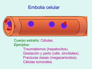 Embolia celular




Cuerpo extraño: Células.
Ejemplos:
     Traumatismos (hepatocitos).
     Gestación y parto (céls. sincitiales).
     Fracturas óseas (megacariocitos).
     Células tumorales.
 