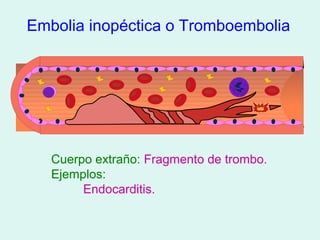 Embolia inopéctica o Tromboembolia




   Cuerpo extraño: Fragmento de trombo.
   Ejemplos:
        Endocarditis.
 