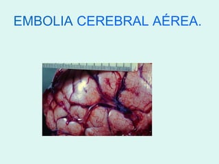 EMBOLIA CEREBRAL AÉREA.
 