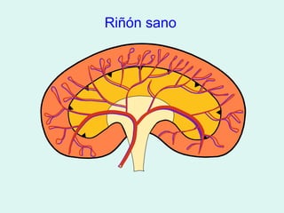 Riñón sano
 