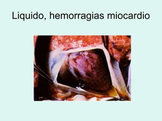 Liquido, hemorragias miocardio
 