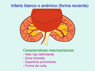 Infarto blanco o anémico (forma reciente)




      Características macroscópicas:
      - Halo rojo delimitante.
      - Zona húmeda.
      - Superficie prominente.
      - Forma de cuña.
 