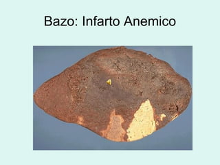 Bazo: Infarto Anemico
 