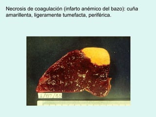Necrosis de coagulación (infarto anémico del bazo): cuña
amarillenta, ligeramente tumefacta, periférica.
 