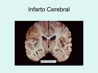 Infarto Cerebral
 