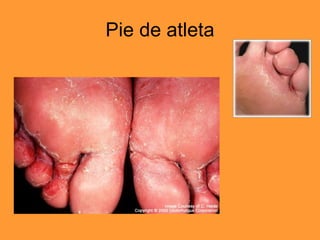 Pie de atleta 