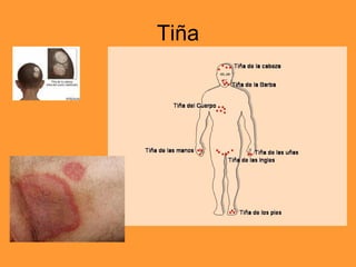 Tiña 