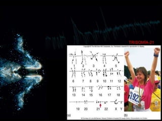      TRISOMÍA-21