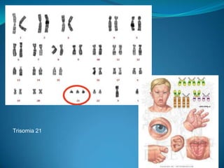 Trisomia 21
 