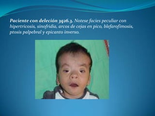 Paciente con deleción 3q26.3. Notese facies peculiar con
hipertricosis, sinofridia, arcos de cejas en pico, blefarofimosis,
ptosis palpebral y epicanto inverso.
 