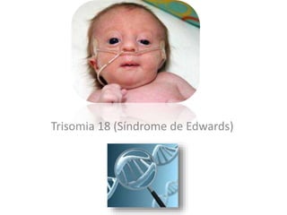 Trisomia 18 (Síndrome de Edwards)
 
