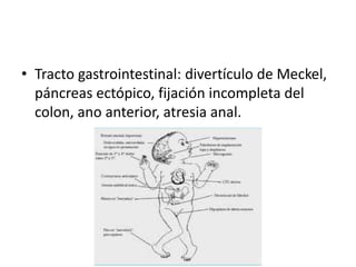 • Tracto gastrointestinal: divertículo de Meckel,
páncreas ectópico, fijación incompleta del
colon, ano anterior, atresia anal.
 