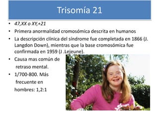 Trisomía 21
• 47,XX o XY,+21
• Primera anormalidad cromosómica descrita en humanos
• La descripción clínica del síndrome fue completada en 1866 (J.
Langdon Down), mientras que la base cromosómica fue
confirmada en 1959 (J .Lejeune).
• Causa mas común de
retraso mental.
• 1/700-800. Más
frecuente en
hombres: 1,2:1
 