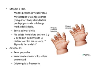 • MANOS Y PIES
– Manos pequeñas y cuadradas
– Metacarpos y falanges cortas
(braquidactilia) y clinodactilia
por hipoplasia de la falange
media del 5 dedo.
– Surco palmar unico
– Pie existe hendidura entre el 1 y
2 dedo con aumento de la
distancia entre los mismos: “
Signo de la sandalia”
• GENITALES
– Pene pequeño
– Volumen testicular < los niños
de su edad
– Criptorquidia frecuente
 