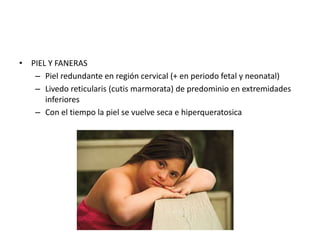 • PIEL Y FANERAS
– Piel redundante en región cervical (+ en periodo fetal y neonatal)
– Livedo reticularis (cutis marmorata) de predominio en extremidades
inferiores
– Con el tiempo la piel se vuelve seca e hiperqueratosica
 