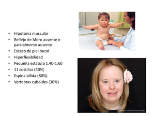 • Hipotonía muscular
• Reflejo de Moro ausente o
parcialmente ausente
• Exceso de piel nucal
• Hiperflexibilidad
• Pequeña estatura 1.40-1.60
• 11 costillas (30%)
• Espina bifida (80%)
• Vertebras cuboides (30%)
 