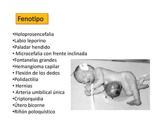 •Holoprosencefalia
•Labio leporino
•Paladar hendido
• Microcefalia con frente inclinada
•Fontanelas grandes
•Hemangioma capilar
• Flexión de los dedos
•Polidactilia
• Hernias
• Arteria umbilical única
•Criptorquidia
•Útero bicorne
•Riñón poloquístico
 