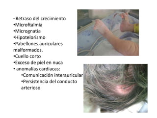 • Retraso del crecimiento
•Microftalmia
•Micrognatia
•Hipotelorismo
•Pabellones auriculares
malformados.
•Cuello corto
•Exceso de piel en nuca
• anomalías cardiacas:
•Comunicación interauricular
•Persistencia del conducto
arterioso
 