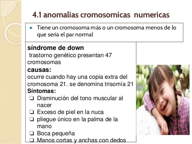 Resultado de imagen de anomalías genéticas y cromosómicas down