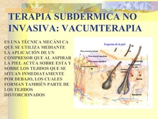 TERAPIA SUBDERMICA NO 
INVASIVA: VACUMTERAPIA 
ES UNA TÉCNICA MECÁNI CA 
QUE SE UTILIZA MEDIANTE 
LA APLICACIÓN DE UN 
COMPRESOR QUE AL ASPIRAR 
LA PIEL ACTÚA SOBRE ESTA Y 
SOBRE LOS TEJIDOS QUE SE 
SITUAN INMEDIATAMENTE 
POR DEBAJO, LOS CUALES 
FORMAN TAMBIÉN PARTE DE 
LOS TEJIDOS 
DISTORCIONADOS 
Epidermis 
Musculo erector 
de pelo 
Glandula 
sebácea 
Dermis 
Hipodermis 
Esquema de la piel 
Plexo arterial profundo Pelo 
Plexo arterial superficial 
Plexo venoso superficial 
Plexo venoso profundo 
 