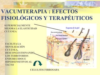 VACUMTERAPIA : EFECTOS 
FISIOLÓGICOS Y TERAPÉUTICOS 
SUPERFICIALMENTE 
MEJORA LA ELASTICIDAD 
CUTÁNEA 
FACILITA LA 
MOVILIZACIÓN 
CUTÁNEA, 
DESCONGESTIONANDO 
LOS TERRITORIOS 
ENDURECIDOS E 
HIPERSENSITIVOS AL 
TACTO 
CELULITIS FIBROSADA 
Epidermis 
Musculo erector 
de pelo 
Glandula 
sebácea 
Dermis 
Hipodermis 
Esquema de la piel 
Plexo arterial profundo Pelo 
Plexo arterial superficial 
Plexo venoso superficial 
Plexo venoso profundo 
 