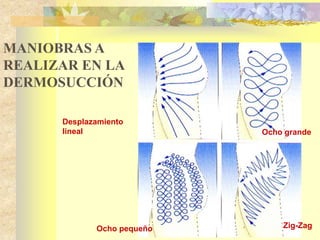 Ocho grande 
MANIOBRAS A 
REALIZAR EN LA 
DERMOSUCCIÓN 
Desplazamiento 
lineal 
Ocho pequeño Zig-Zag 
 