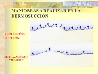 MANIOBRAS A REALIZAR EN LA 
DERMOSUCCIÓN 
PERCUSIÓN-SUCCIÓN 
DESPLAZAMIENTO-VIBRACIÓN 
 