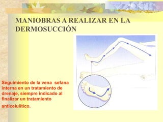 MANIOBRAS A REALIZAR EN LA 
DERMOSUCCIÓN 
Seguimiento de la vena sefana 
interna en un tratamiento de 
drenaje, siempre indicado al 
finalizar un tratamiento 
anticelulítico. 
 