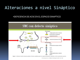 Alteraciones a nivel Sináptico
•DEFICIENCIA DE AChE EN EL ESPACIO SINAPTICO
 