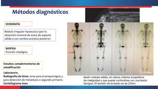 CANCER DE MAMA
Testa, R. (2012). Ginecología. Argentina: Médica Panamericana. (BCQS02111).
Vias de propagación
• Vías linf...