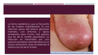  La forma epidémica, que es frecuente
en las mujeres hospitalizadas. Es una
infección grave del sistema glandular
mamario, con síntomas y signos
semejantes pero mucho más agudos
que los de la mastitis esporádica. La
infección es transmitida por una
persona portadora del Staphylococcus
aureus al lactante, quien la extiende al
sistema ductal de la madre.
 