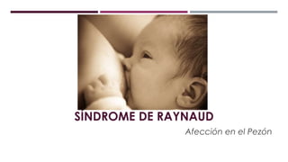 SÍNDROME DE RAYNAUD
Afección en el Pezón
 